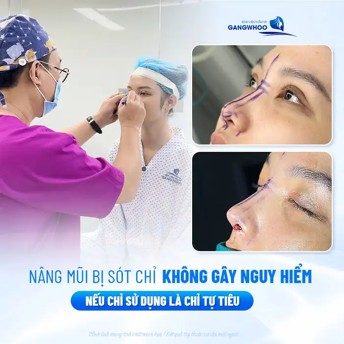 Nâng mũi bị cắt sót chỉ có sao không? Cách xử lý như thế nào?