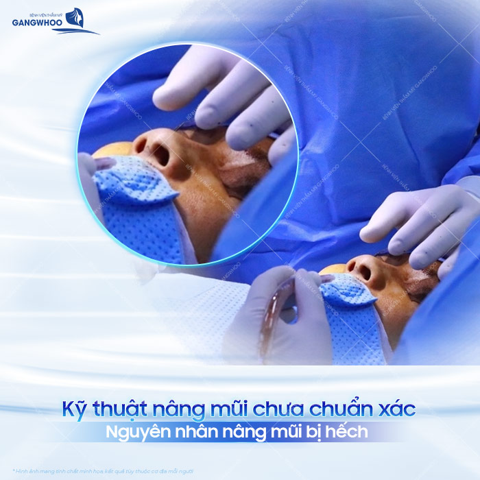 Nâng mũi xong bị hếch nguyên nhân do đâu? Cách xử lý mũi bị hếch sau nâng như thế nào?