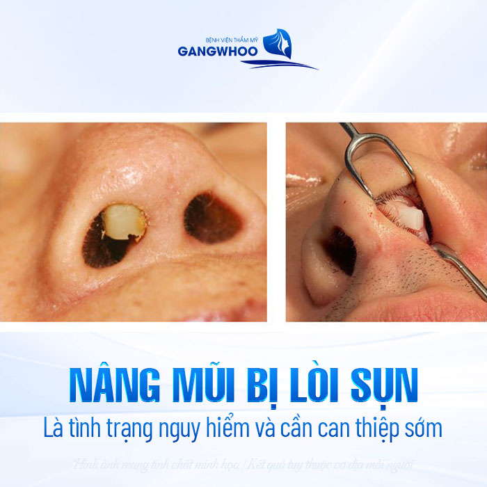 Nâng mũi bị lòi sụn bên trong có nguy hiểm không? Cách xử lý như thế nào?