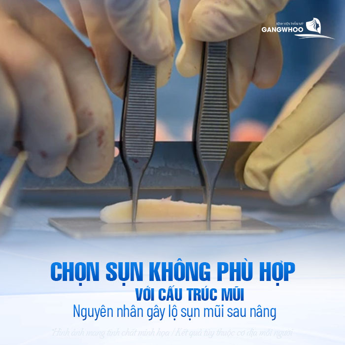 Nâng mũi bị lòi sụn bên trong có nguy hiểm không? Cách xử lý như thế nào?