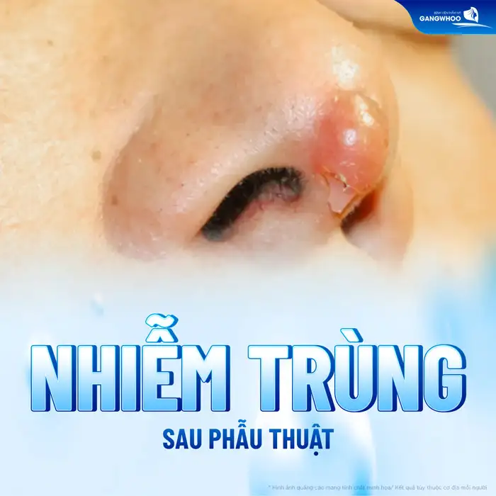 Nâng mũi bị nhức kéo dài có nguy hiểm không? Nguyên nhân do đâu?