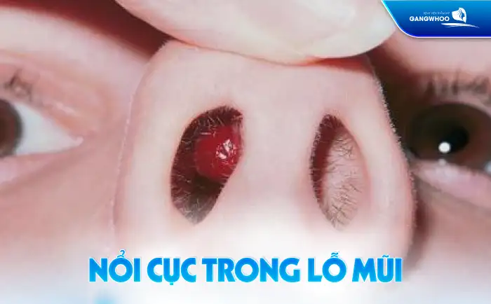 Nâng mũi bị nổi cục trong lỗ mũi có nguy hiểm không? Cần xử lý ra sao?