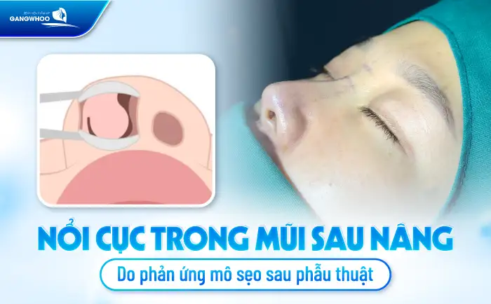 Nâng mũi bị nổi cục trong lỗ mũi có nguy hiểm không? Cần xử lý ra sao?