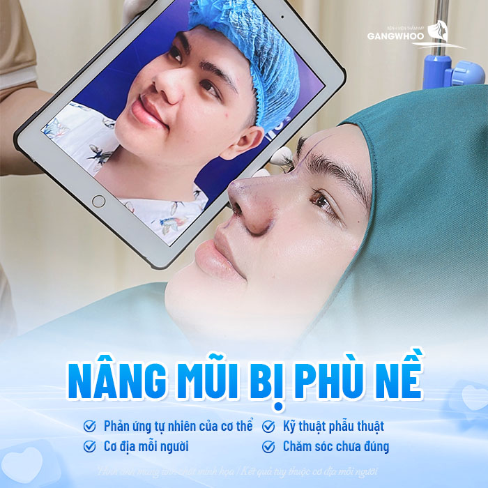 Nâng mũi bị phù nề có bình thường không và làm sao giảm phù hiệu quả?