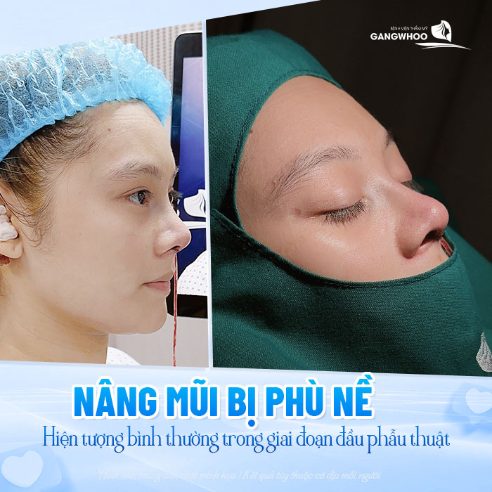 Nâng mũi bị phù nề có bình thường không và làm sao giảm phù hiệu quả?