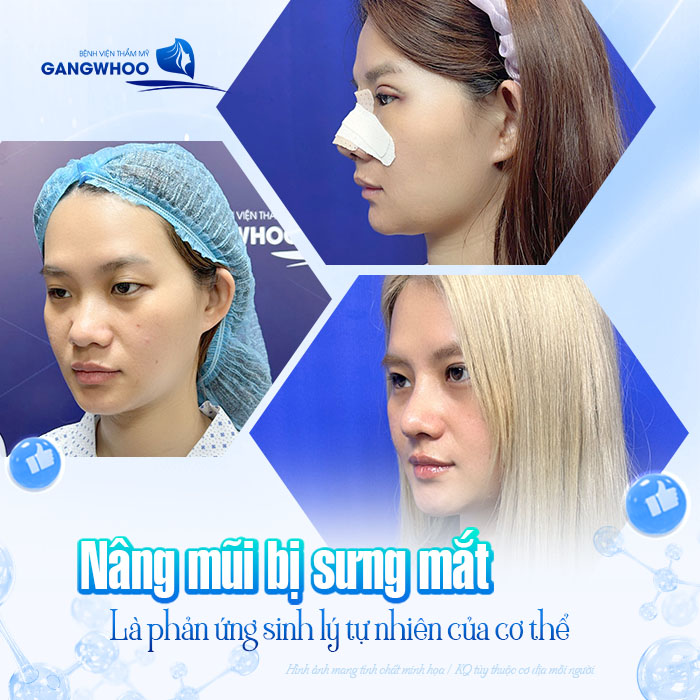 Nâng mũi bị sưng mắt sau phẫu thuật có nguy hiểm không? Làm sao giảm sưng nhanh?