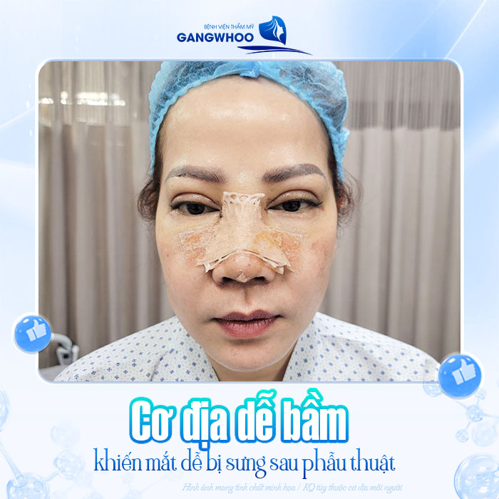 Nâng mũi bị sưng mắt sau phẫu thuật có nguy hiểm không? Làm sao giảm sưng nhanh?