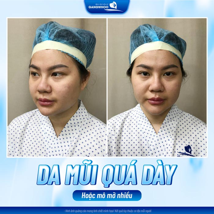 Nâng mũi xong bị thấp quá có sao không? Có sửa được không? 1 Nâng mũi xong bị thấp quá có sao không? Có sửa được không?