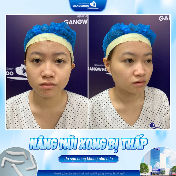 Nâng mũi xong bị thấp quá có sao không? Có sửa được không? 2 Nâng mũi xong bị thấp quá có sao không? Có sửa được không?