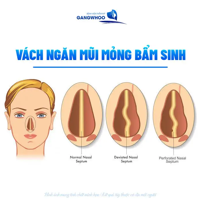 Nguyên nhân nâng mũi bị thủng vách ngăn là gì? Cách xử lý như thế nào?