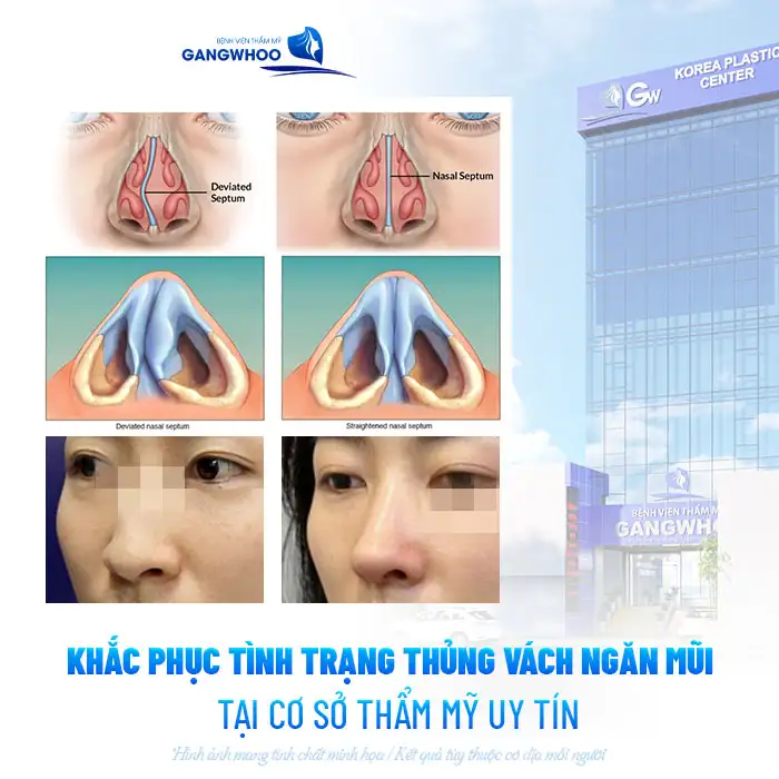 Nguyên nhân nâng mũi bị thủng vách ngăn là gì? Cách xử lý như thế nào?