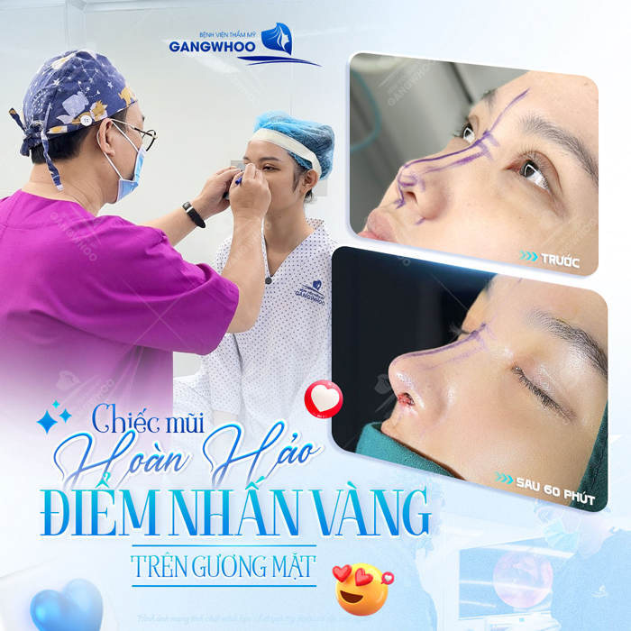 Nâng mũi cấu trúc mini là gì? Ưu, nhược điểm của nâng mũi cấu trúc mini