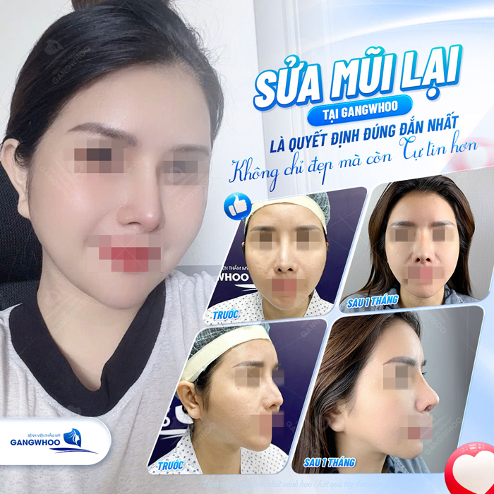 Nâng mũi cấu trúc có sửa lại được không? Chi phí liệu có cao không?