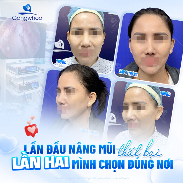 Nâng mũi cấu trúc có sửa lại được không? Chi phí liệu có cao không?