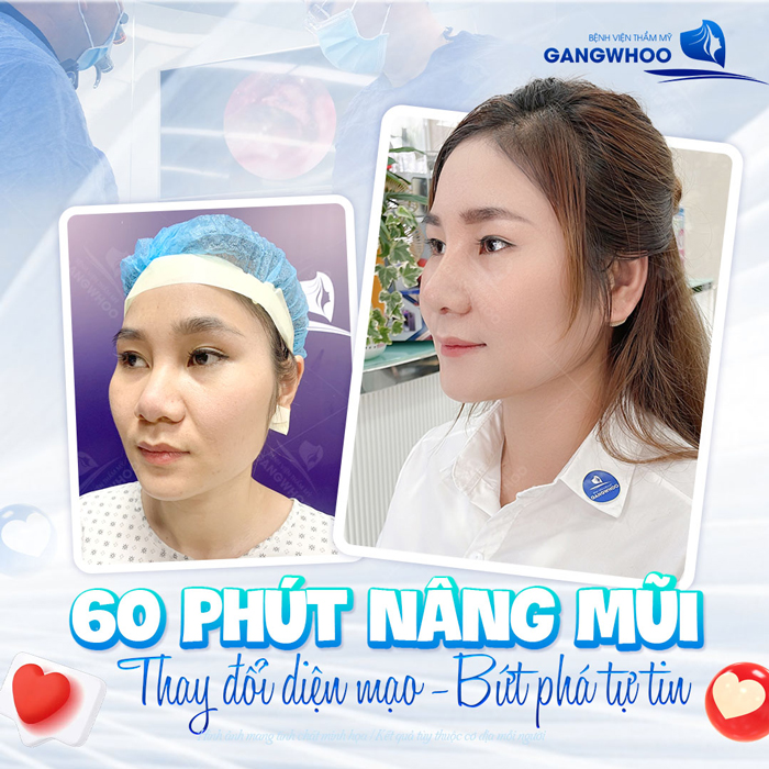 Nâng mũi cấu trúc có sửa lại được không? Chi phí liệu có cao không?