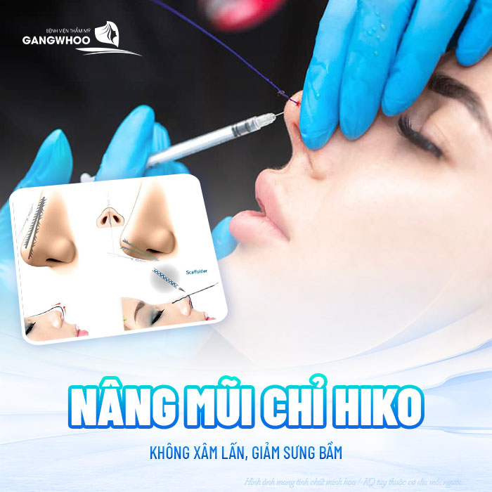 Nâng mũi chỉ Hiko là gì? Nâng mũi chỉ hiko có tốt không?