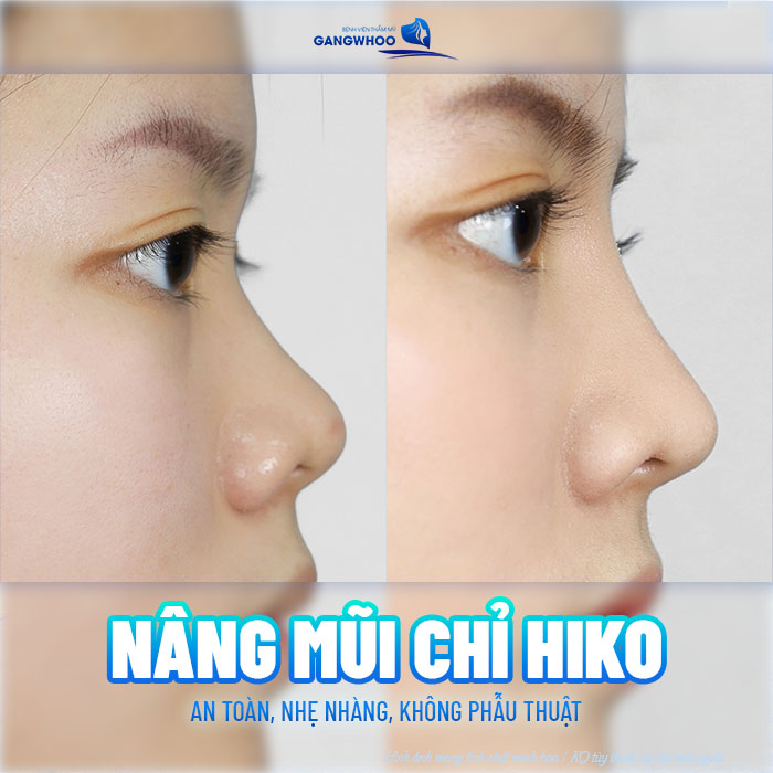 Nâng mũi chỉ Hiko là gì? Nâng mũi chỉ hiko có tốt không?