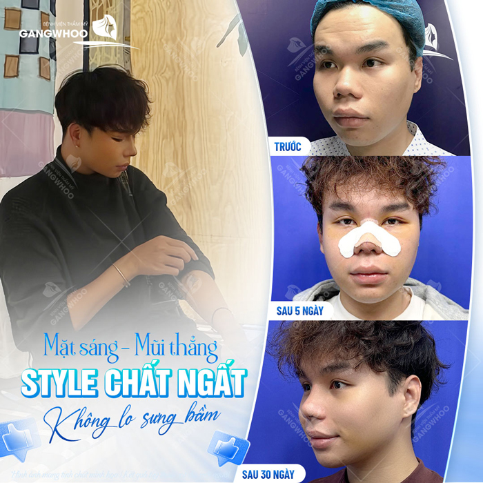 Phương pháp nâng mũi cho người mũi to an toàn, tự nhiên