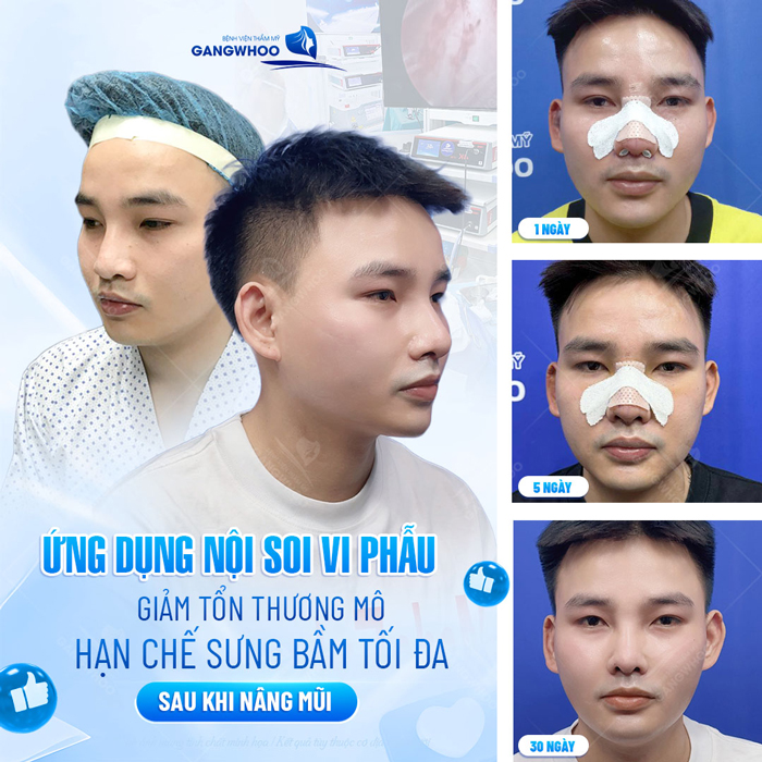 Phương pháp nâng mũi cho người mũi to an toàn, tự nhiên