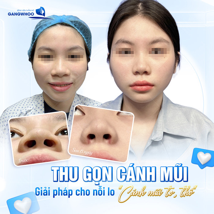 Phương pháp nâng mũi cho người mũi to an toàn, tự nhiên