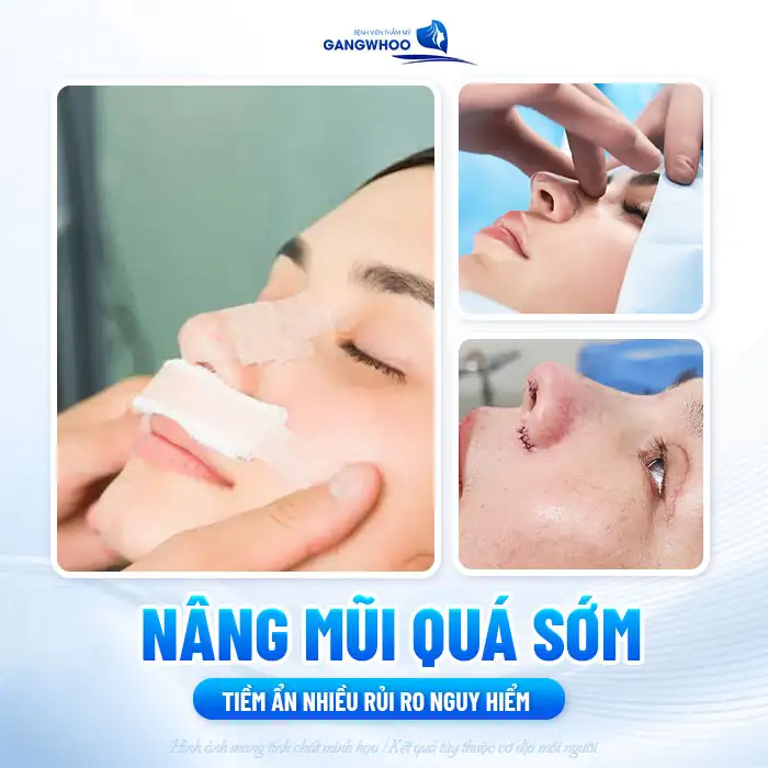 Nâng mũi cho trẻ em nên hay không? Cần lưu ý gì? 1 Nâng mũi cho trẻ em nên hay không? Cần lưu ý gì?