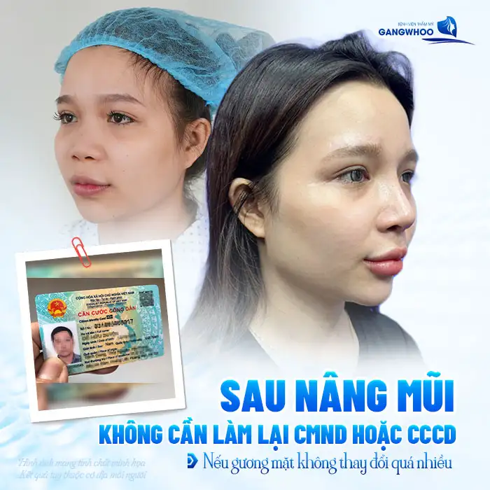Nâng mũi có cần làm lại CMND không? Thủ tục như thế nào?