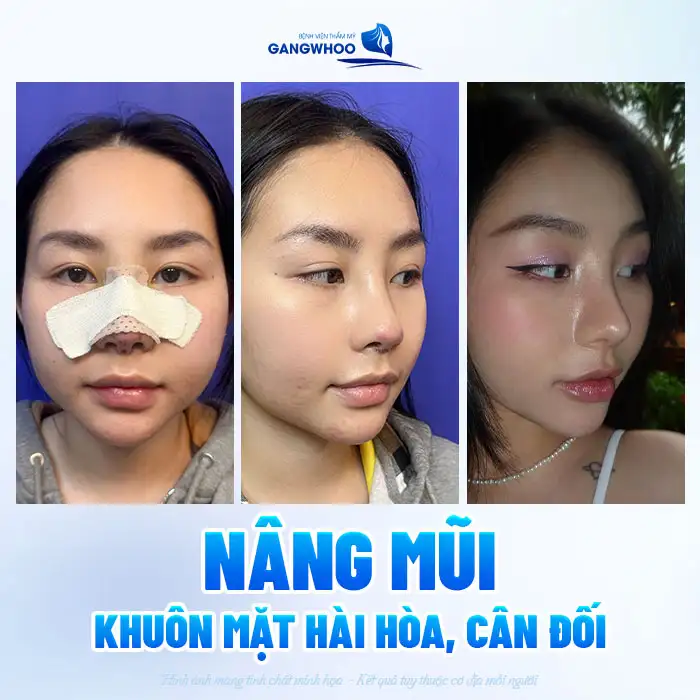 Nâng mũi có cần phải làm lại hộ chiếu, passport không?