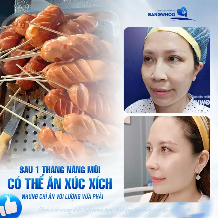 Nâng mũi có được ăn xúc xích không? Cần tránh những loại thực phẩm nào sau nâng mũi?