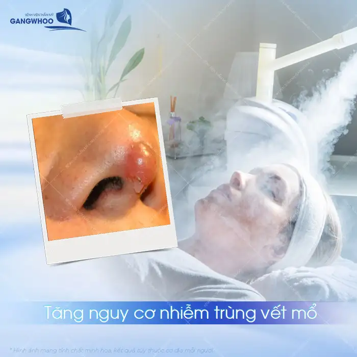 Nâng mũi có được xông mặt sau khi phẫu thuật không? Cần lưu ý những gì?