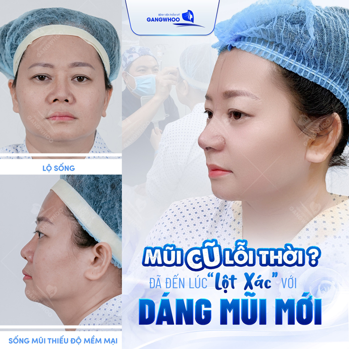 Nâng mũi có giảm tuổi thọ không? Có ảnh hưởng sức khỏe?