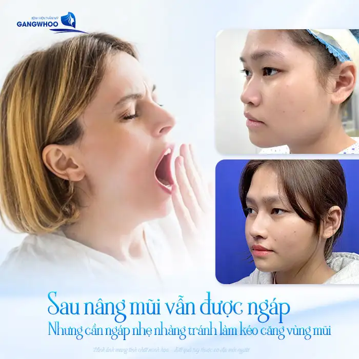 Nâng mũi có được ngáp không? Có ảnh hưởng đến dáng mũi không?