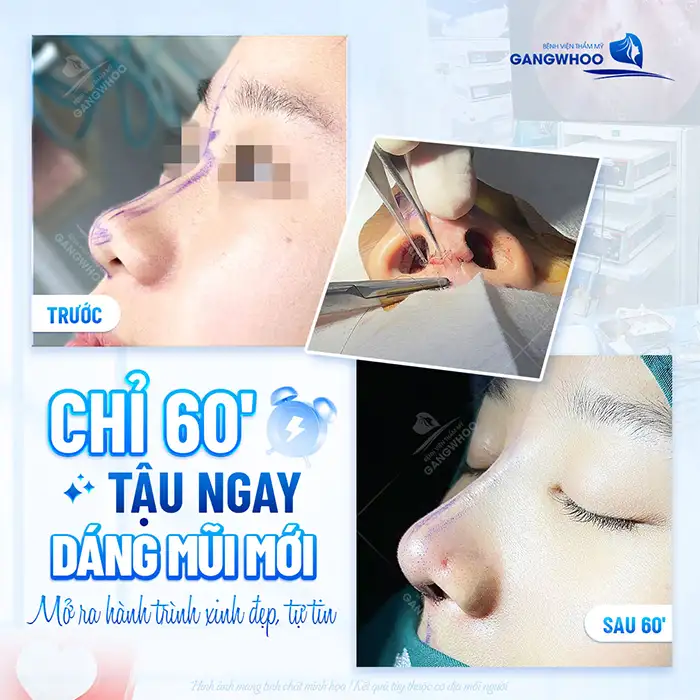 Sau nâng mũi đầu mũi bị nhọn nguyên nhân do đâu? Cách xử lý như thế nào?