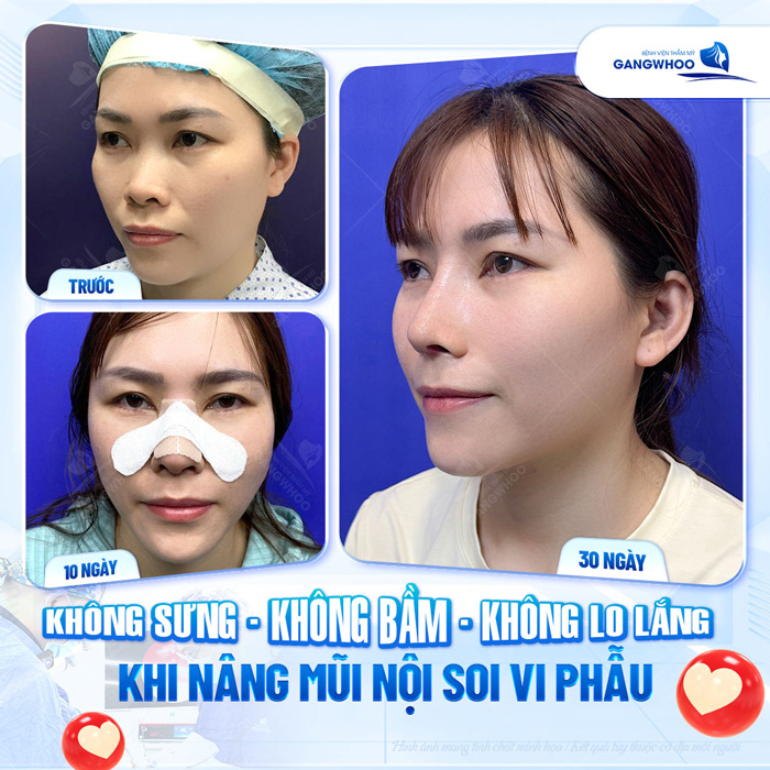 Nâng mũi điêu khắc là gì? Ưu, nhược điểm của phương pháp nâng mũi điêu khắc