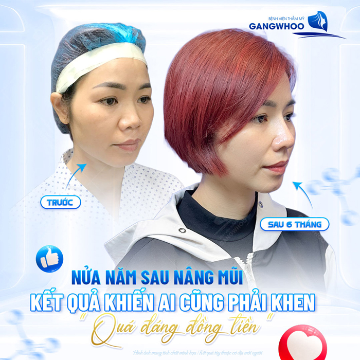 Nâng mũi Ergonomic là gì? Ưu, nhược điểm của phương pháp Ergonomic