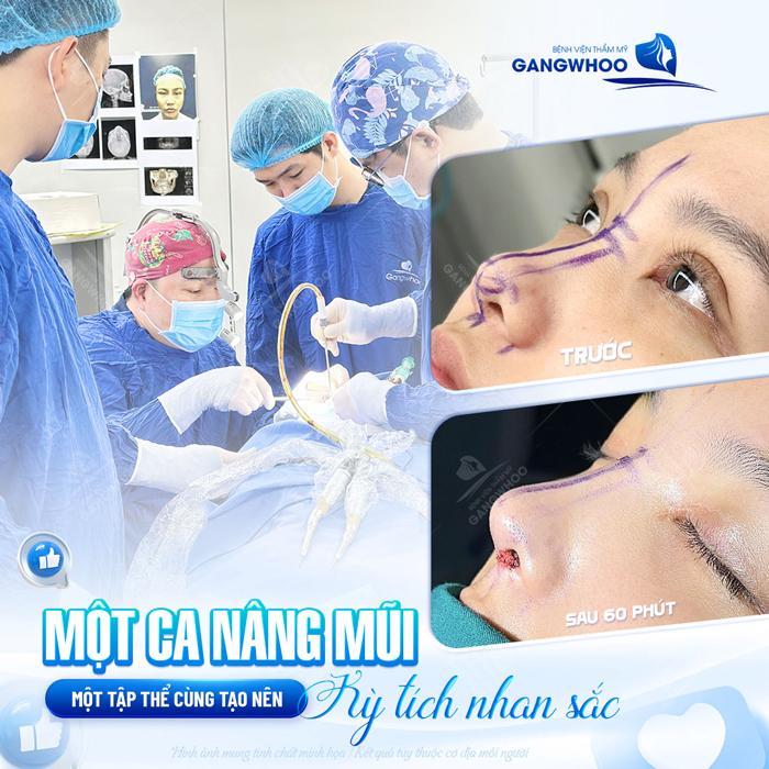 Nâng mũi Ergonomic là gì? Ưu, nhược điểm của phương pháp Ergonomic