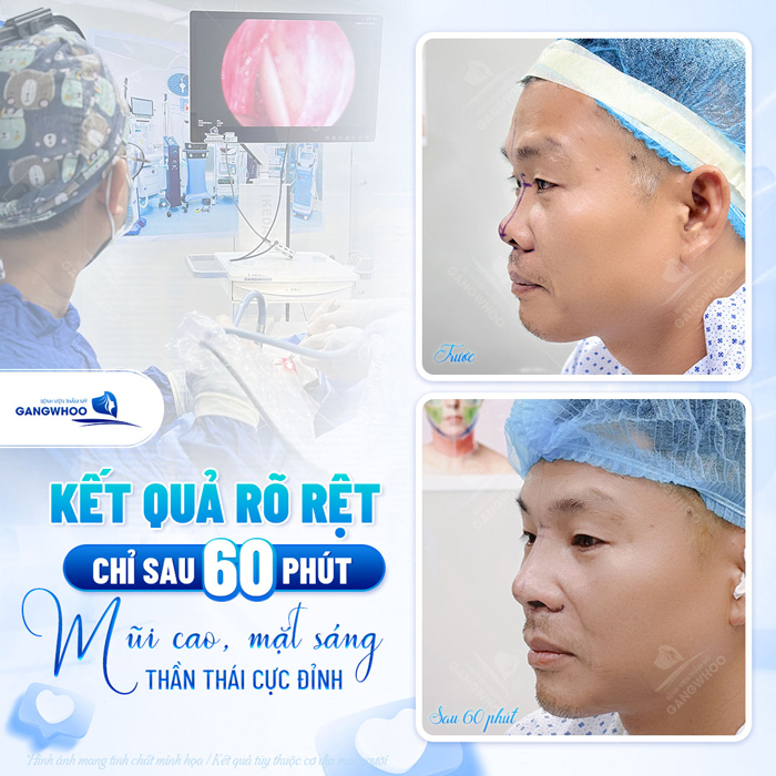 Nâng mũi Ergonomic là gì? Ưu, nhược điểm của phương pháp Ergonomic