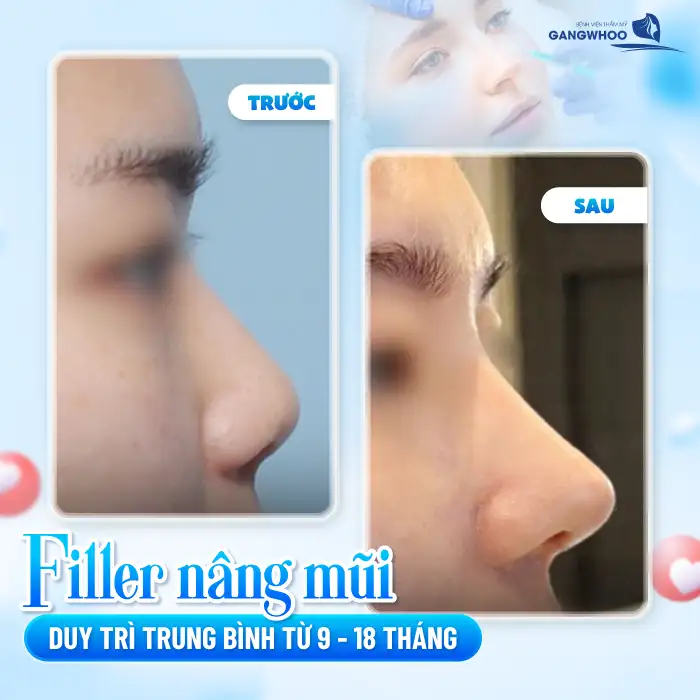 Nâng mũi filler giữ được bao lâu? Bao lâu thì tan?
