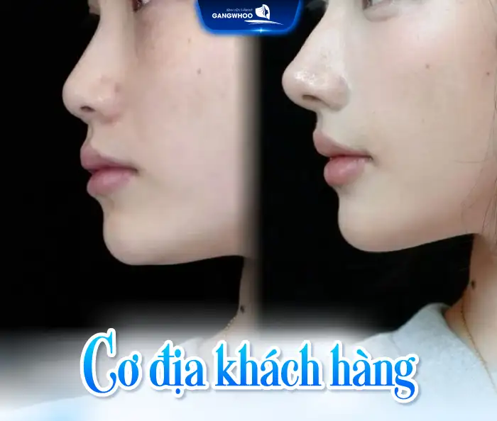 Nâng mũi filler giữ được bao lâu? Bao lâu thì tan?