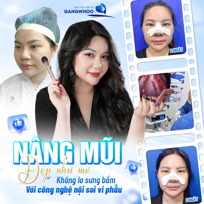 Nâng mũi Hàn Quốc có vĩnh viễn không? Cách chăm sóc duy trì dáng mũi lâu dài