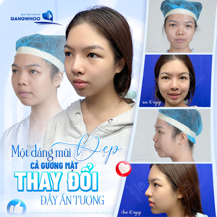 Nâng mũi Hàn Quốc có vĩnh viễn không? Cách chăm sóc duy trì dáng mũi lâu dài