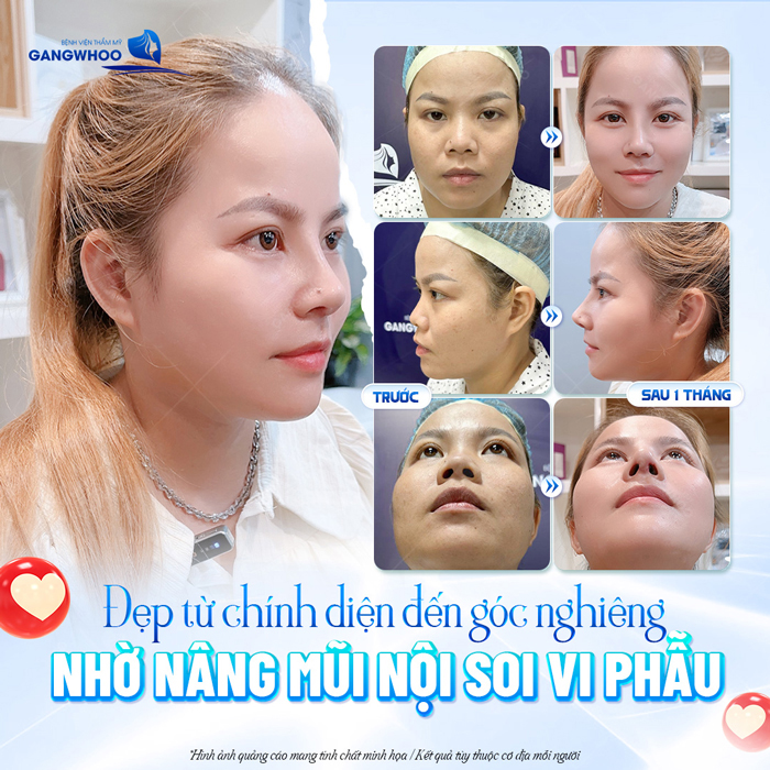 Nâng mũi lần 2 có đau không? Chia sẻ kinh nghiệm khi nâng mũi lần 2