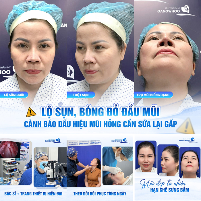 Nâng mũi lần 2 có đau không? Chia sẻ kinh nghiệm khi nâng mũi lần 2