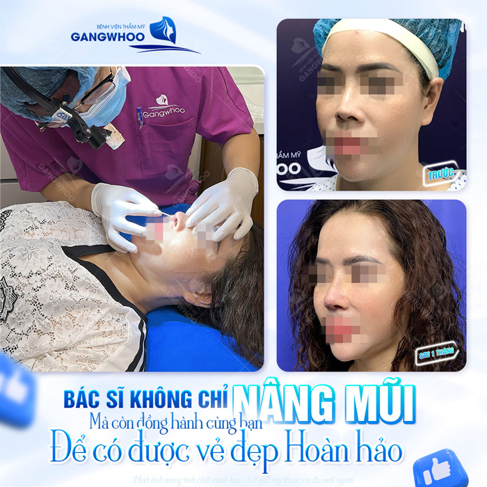 Nâng mũi lần 2 có đau không? Chia sẻ kinh nghiệm khi nâng mũi lần 2