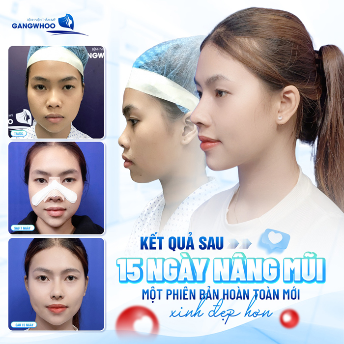 Nâng mũi mấy ngày tháo nẹp? Có được théo nẹp sớm không?