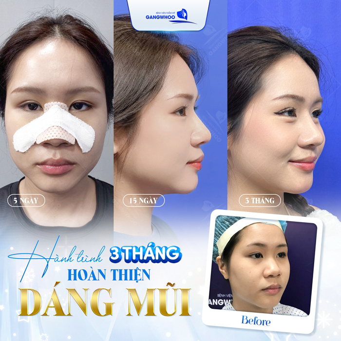 Nâng mũi mấy ngày tháo nẹp? Có được théo nẹp sớm không?