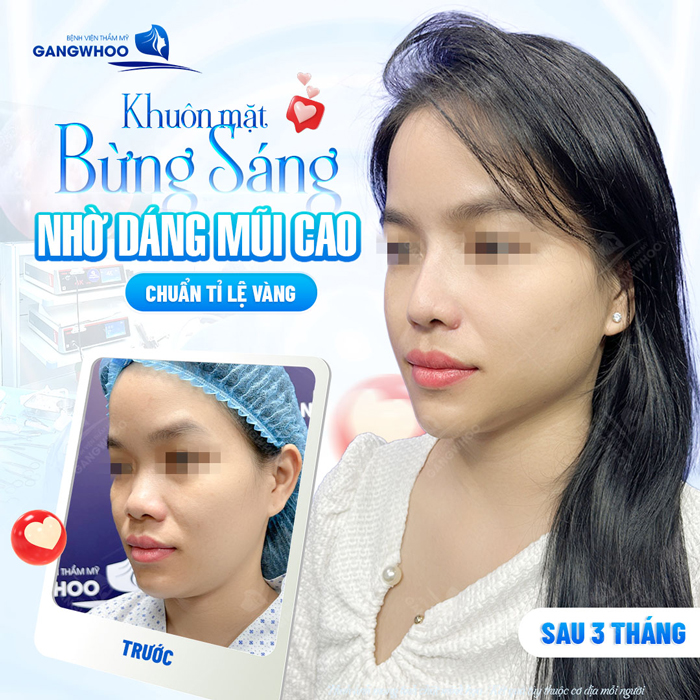 Nâng mũi Medi Form là gì? Ưu, nhược điểm của nâng mũi Medi Form