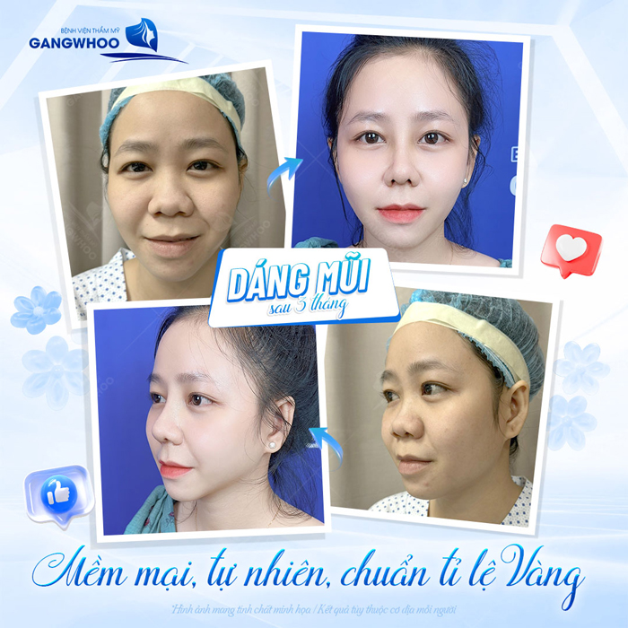 Nâng mũi Medi Form là gì? Ưu, nhược điểm của nâng mũi Medi Form