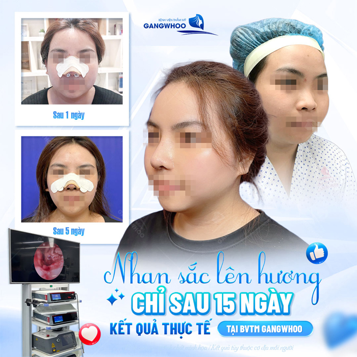 Nâng mũi Medi Form là gì? Ưu, nhược điểm của nâng mũi Medi Form