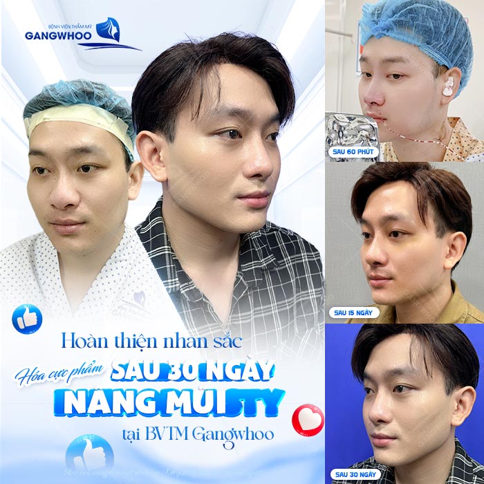 Nâng mũi nam ở đâu đẹp, uy tín tại TPHCM? Top 7 địa chỉ tham khảo