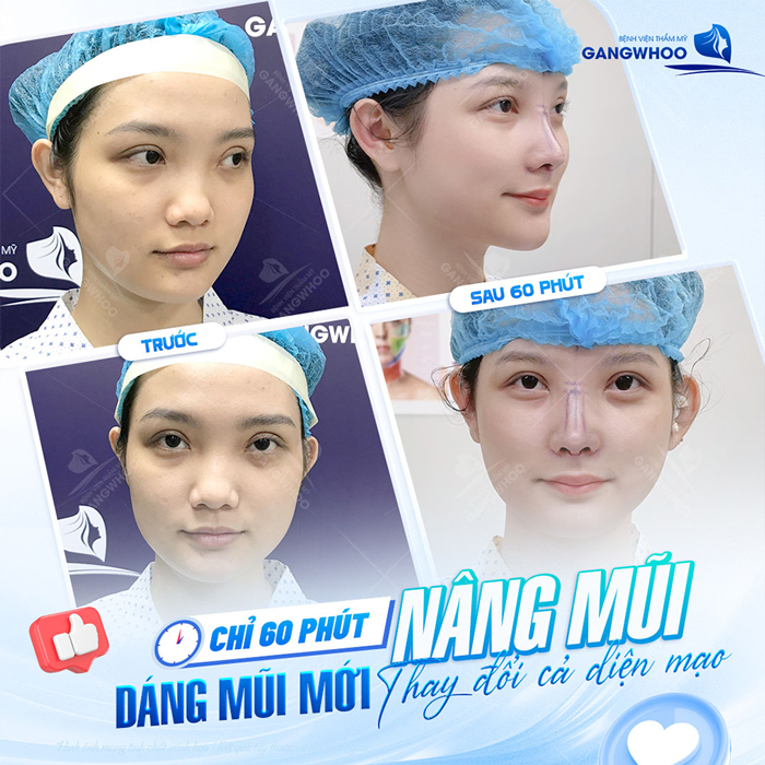 Nâng mũi S Line có được vĩnh viễn không? Thời gian duy trì tối đa bao lâu?